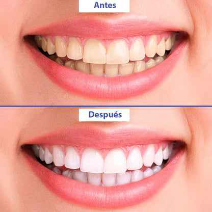 Blanqueador Dental - SuperSmile™